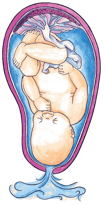 Premature Rupture Of Membranes