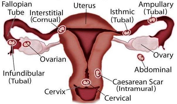 Sites for Ectopic pregnancy