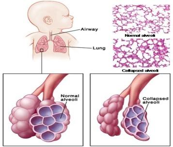 Surfactant, released after injection of corticosteroids helps in preventing alveoli to collapse