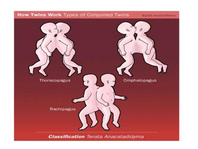 Types of Conjoined Twins