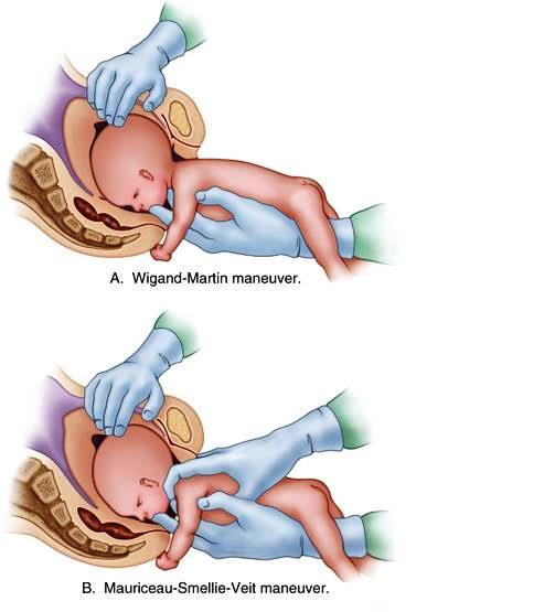 Vaginal-breech-birth