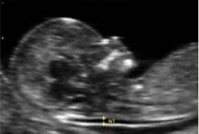 first-trimester-screening