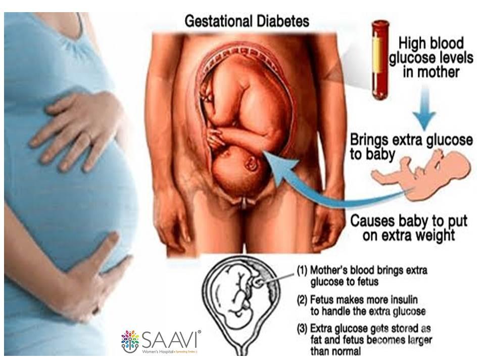 Gestational Diabetes