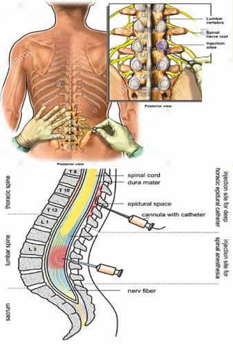painless epidural analgesia