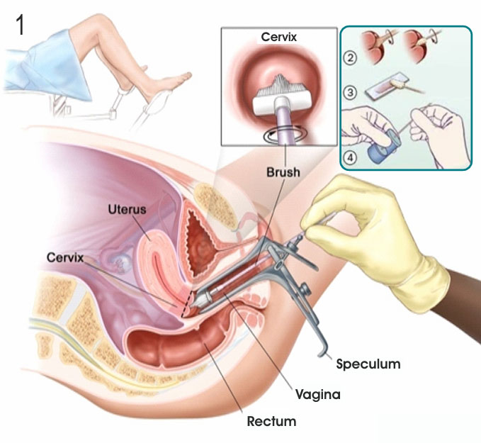 pap-test