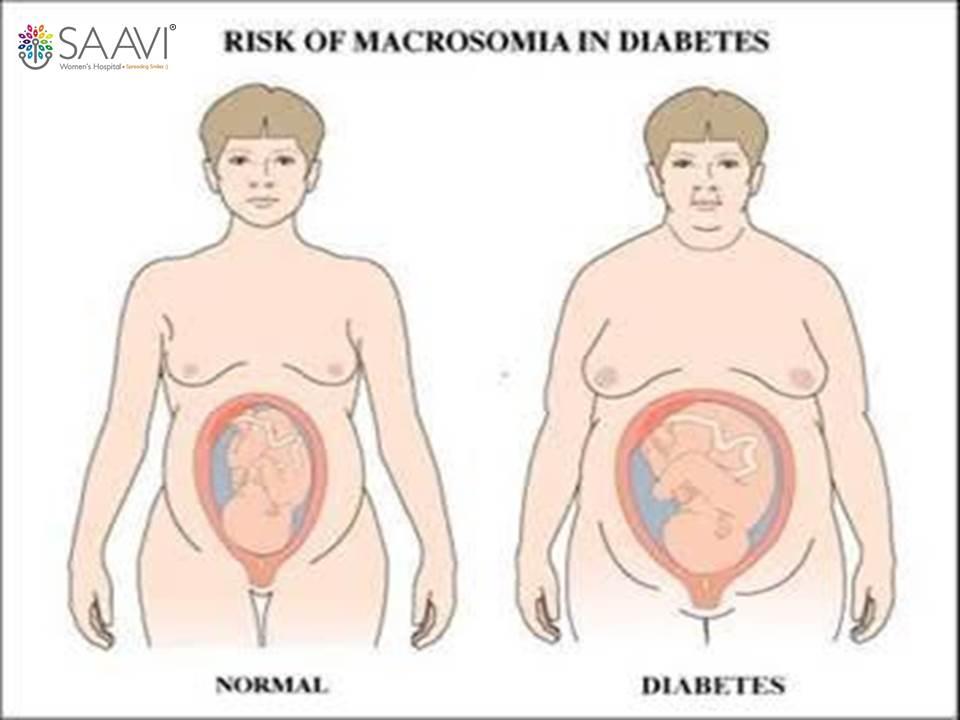 Risk of Macrosomia in baby